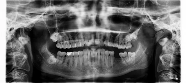 x ray, zähne, zahn fehlt, x ray, x ray, x ray, x ray, x ray, zähne, zähne